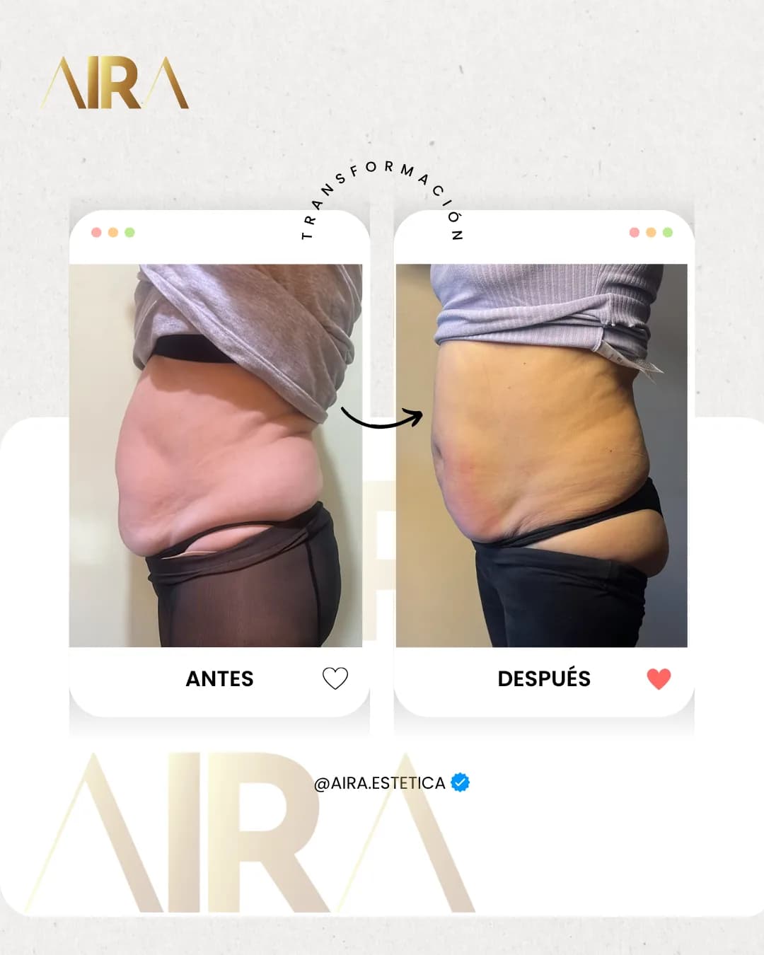 Antes y después de un tratamiento en abdomen y flancos, de perfil