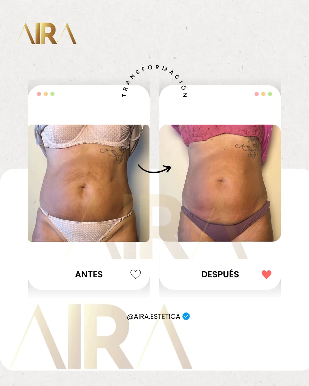 Antes y después de un tratamiento en abdomen, de frente
