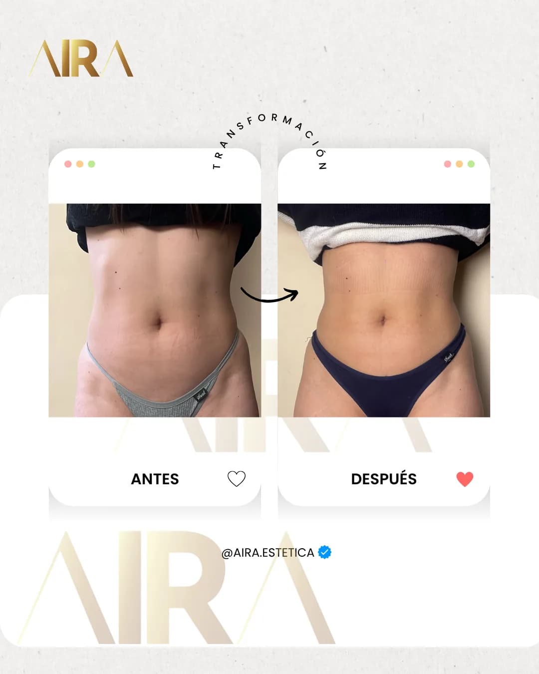 Antes y después de un tratamiento en abdomen, de frente