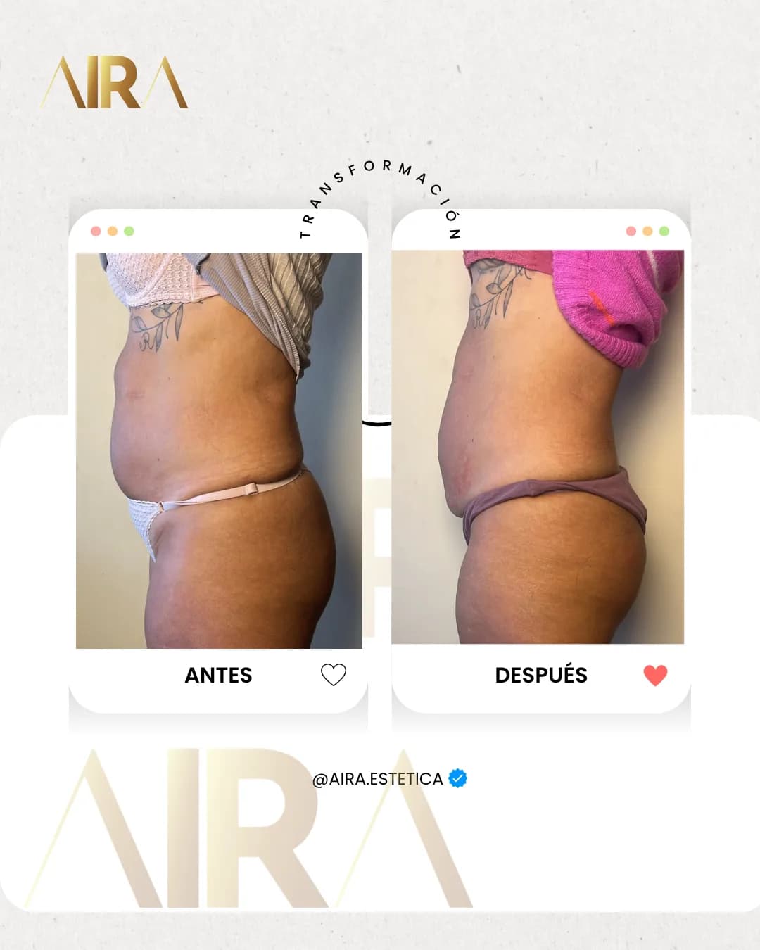Antes y después de un tratamiento en abdomen y glúteo, de perfil