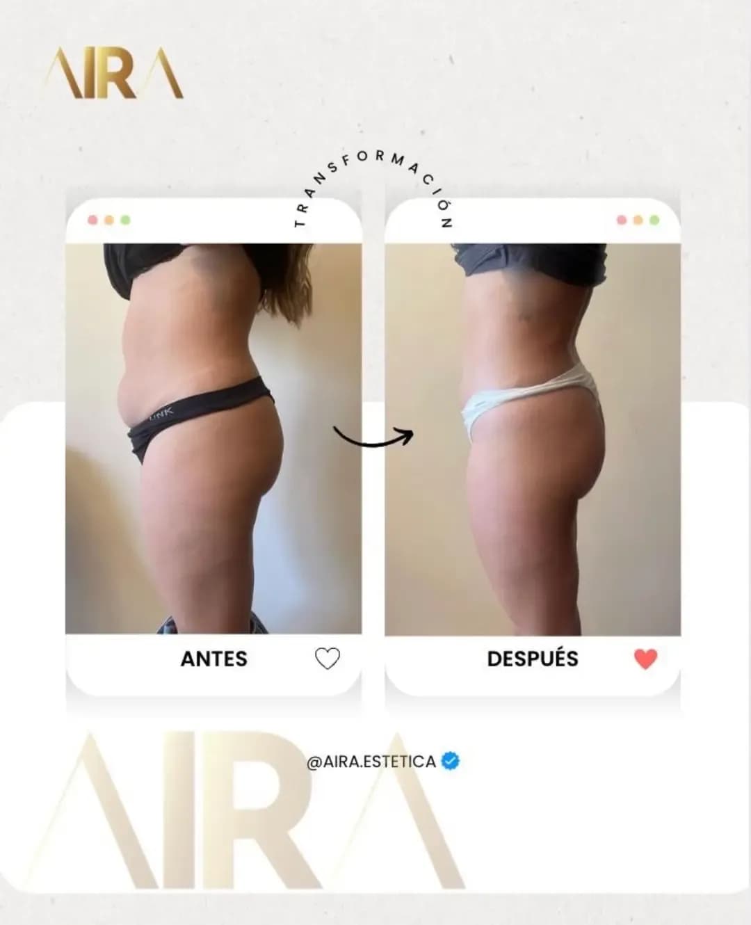 Antes y después de un tratamiento en abdomen y flancos, de perfil