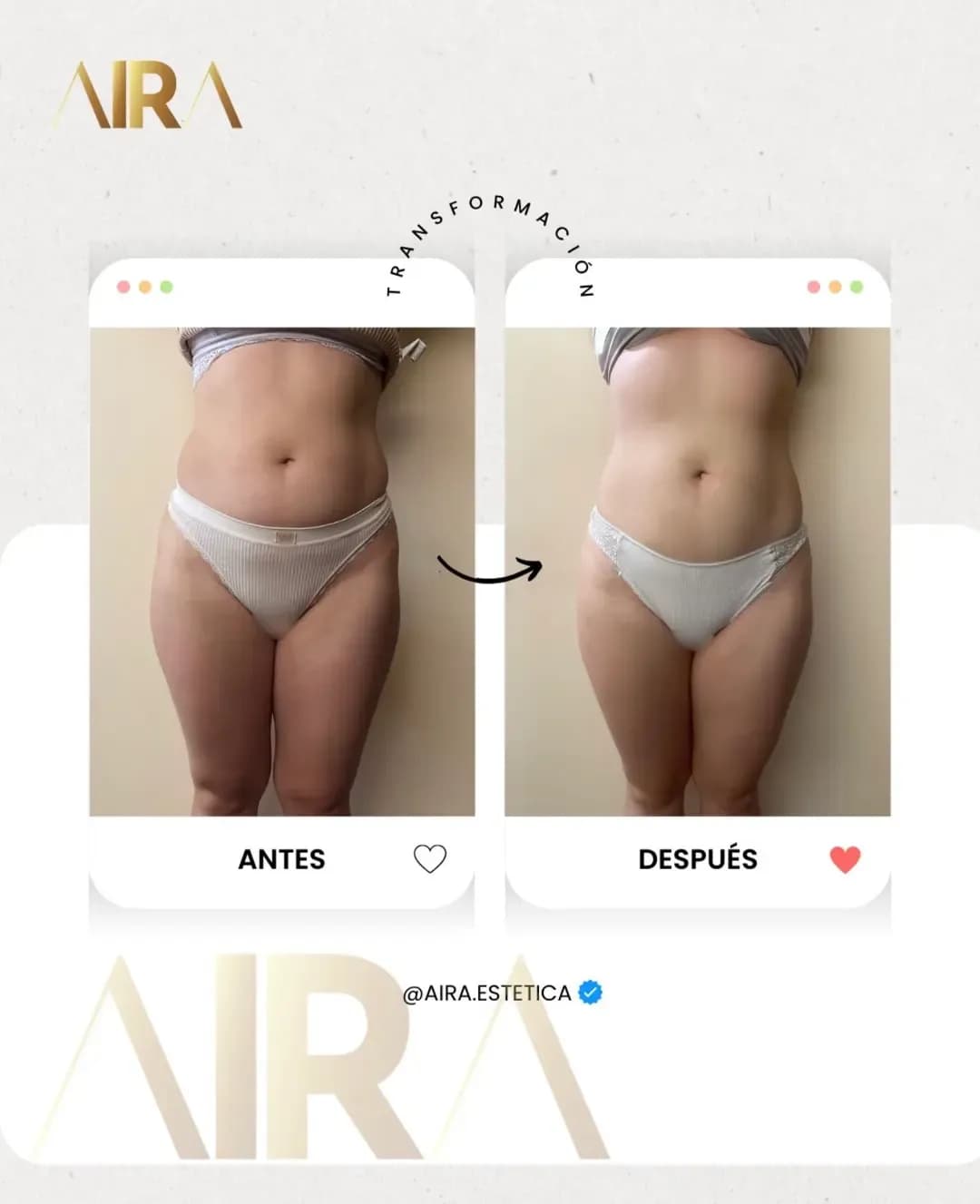 Antes y después de un tratamiento en abdomen y piernas, de frente