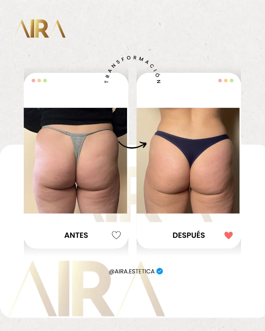 Antes y después de un tratamiento en glúteos y muslos