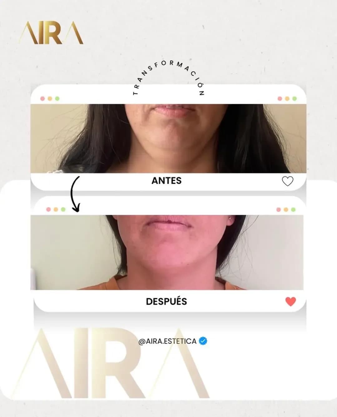 Antes y después de un tratamiento en mentón y cuello