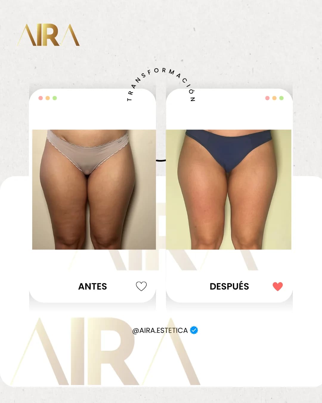 Antes y después de un tratamiento en piernas, de frente